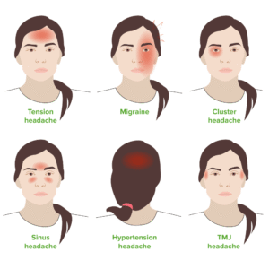 Tension Headaches