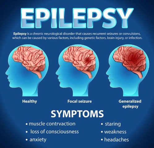 Epilepsy Surgery Specialist India