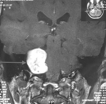Acoustic Neuroma Treatment: Symptoms, Surgery & Radiation