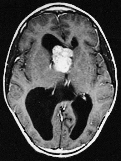 Astrocytoma Treatment: Surgery, Radiation & Follow-Up