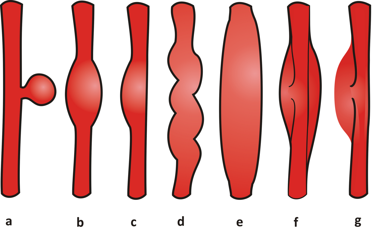 Brain Aneurysm Treatment: Symptoms, Diagnosis & Options