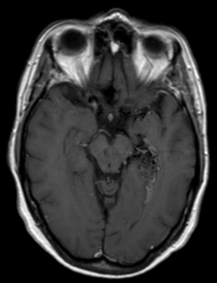 Brain AVM Treatment: Surgery, Radiosurgery & Recovery