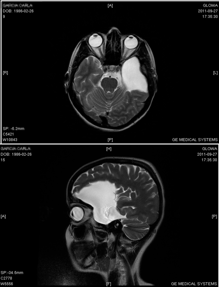 Brain Cyst Treatment: Types, Surgery & Monitoring