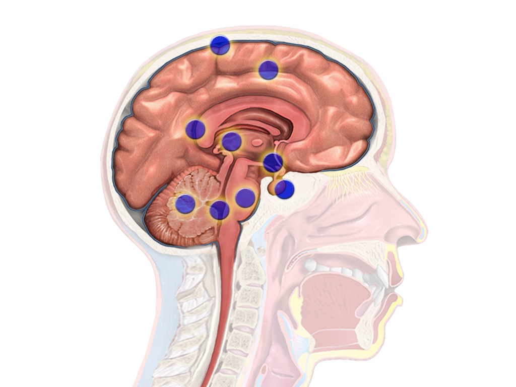 Brain Tumor Treatment: Symptoms, Diagnosis & Best Options