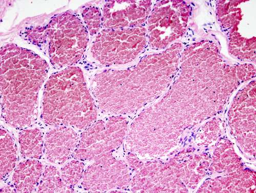 Cavernoma Treatment: Symptoms, Surgery & Monitoring