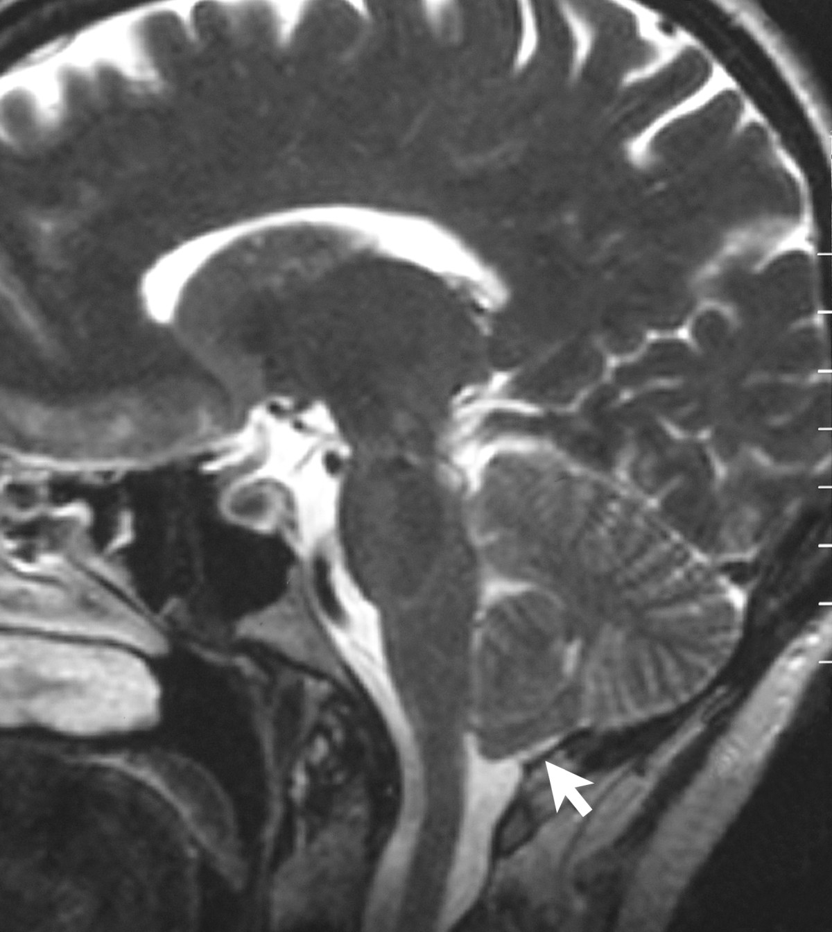 Chiari malformation treatment planning on sagittal brain MRI scan