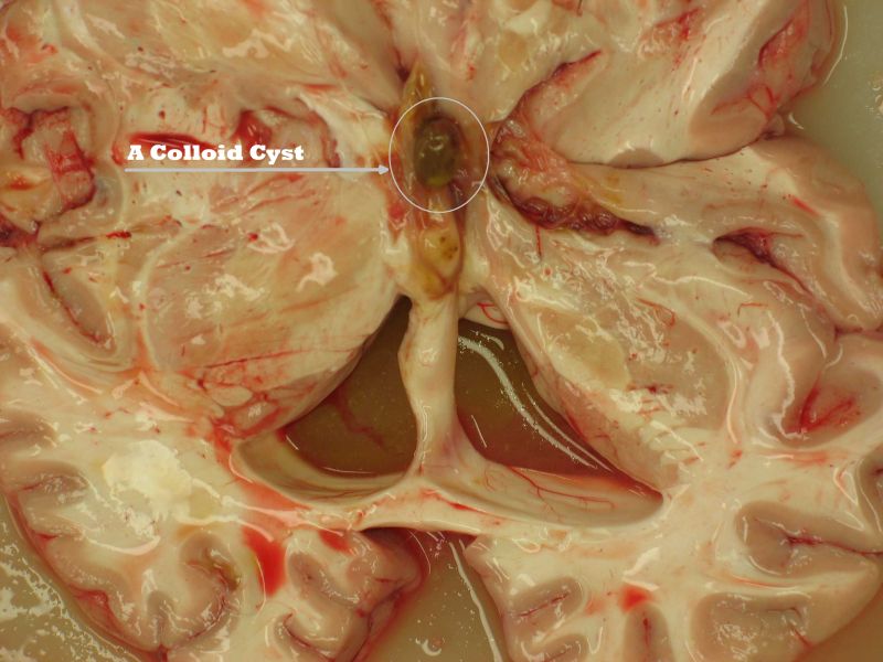 Colloid Cyst Treatment: Symptoms, Surgery & Recovery