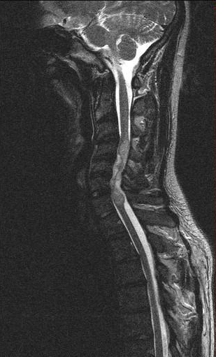 Ependymoma Treatment: Surgery, Radiation & Follow-Up