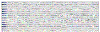 Epilepsy Surgery: When It Helps, Types & Recovery