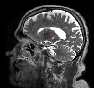 Essential tremor treatment planning on an MRI-guided procedure scan