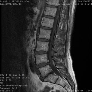 Failed back surgery syndrome assessment on a lumbar spine MRI