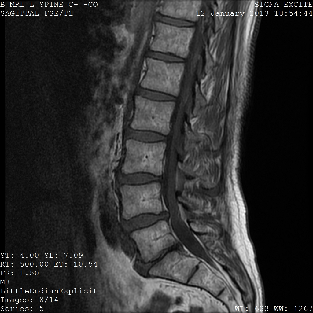 Failed back surgery syndrome assessment on a lumbar spine MRI