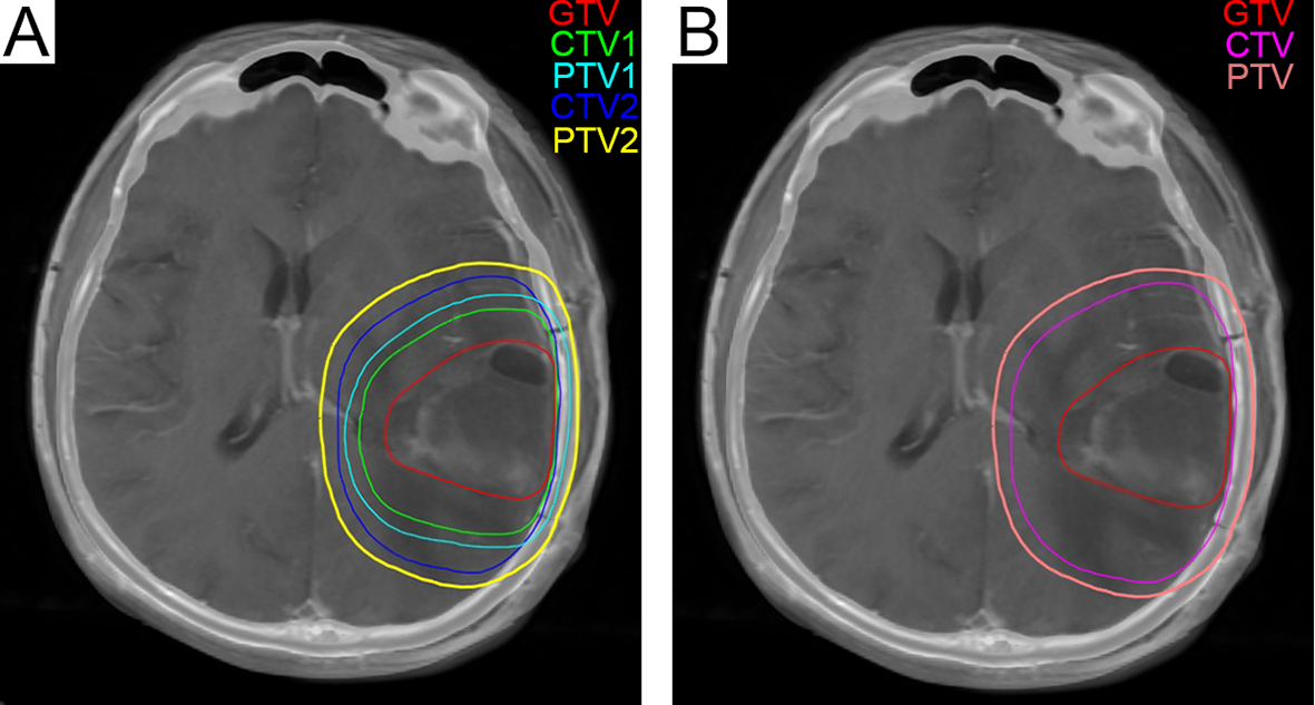 Glioblastoma Treatment: Surgery, Radiation & New Options