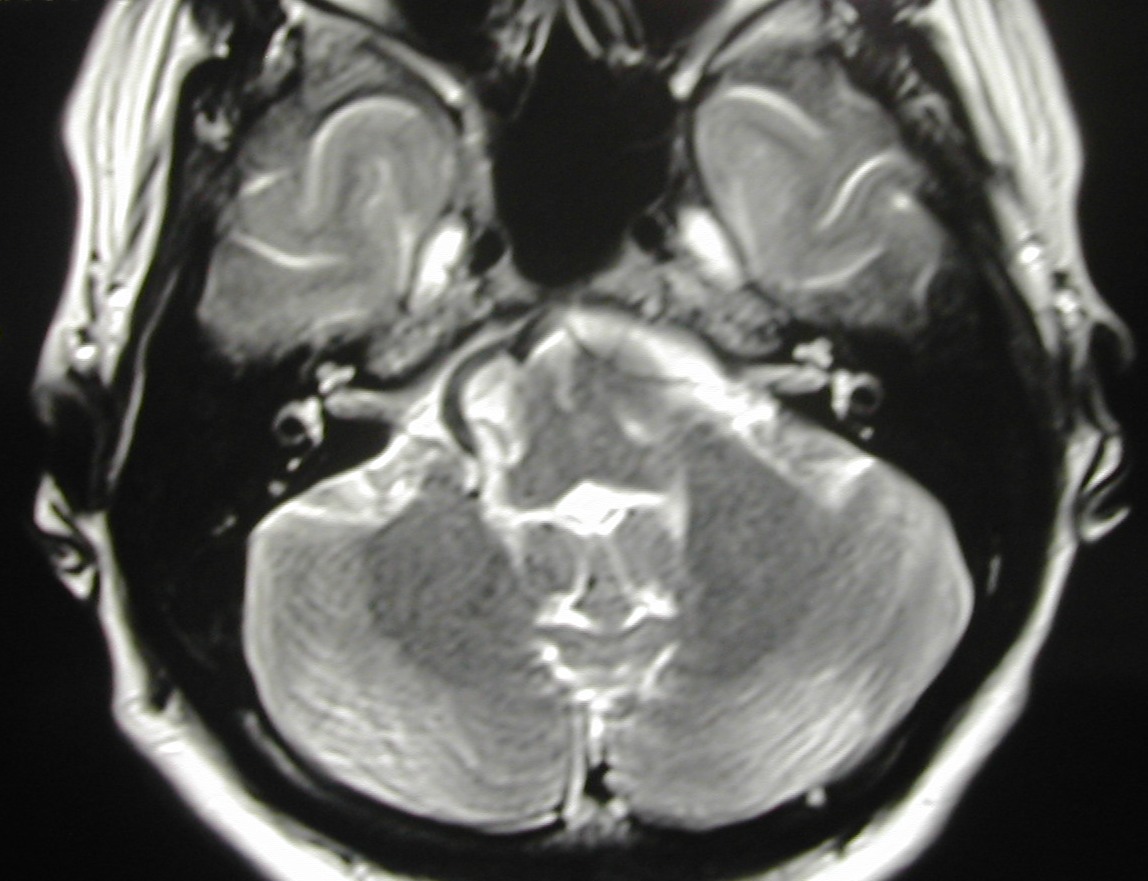 Hemifacial Spasm Treatment: Causes, Relief & Surgery