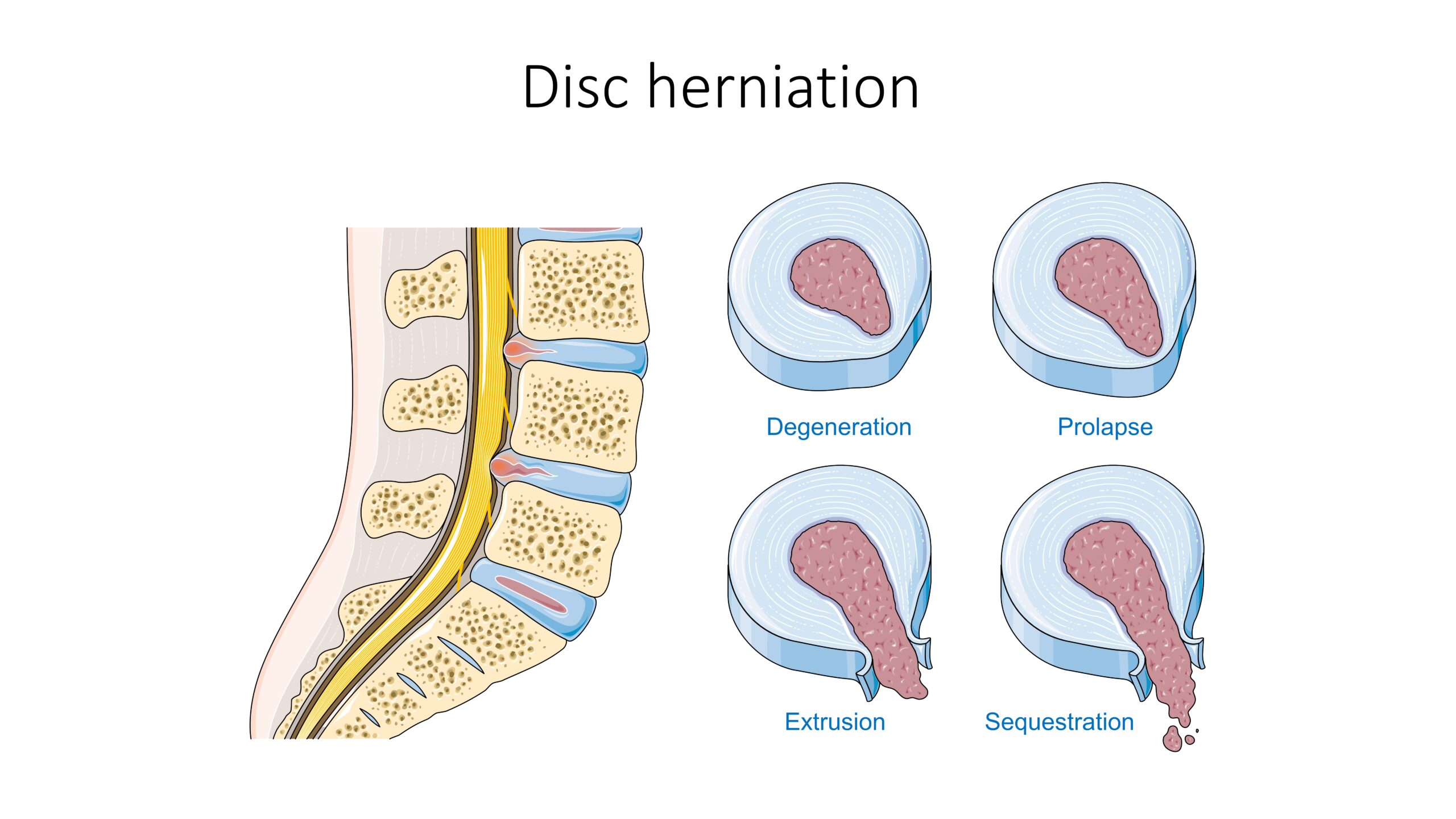 Herniated Disc Treatment: Symptoms, Relief & Surgery