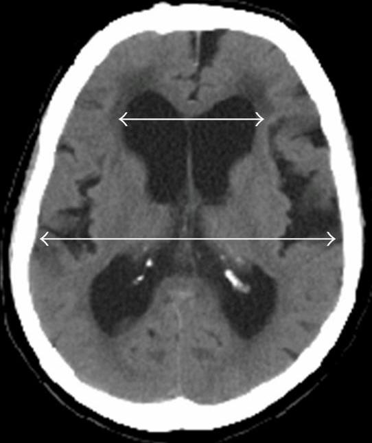 Hydrocephalus Treatment: Shunt Surgery, Options & Recovery