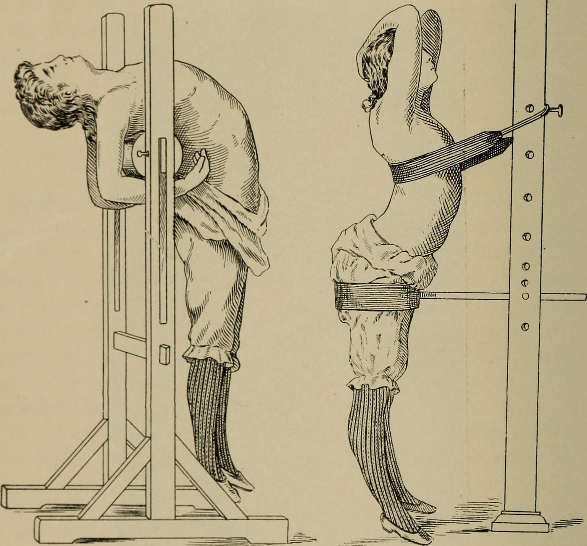 Kyphosis Treatment: Symptoms, Bracing & Spine Surgery