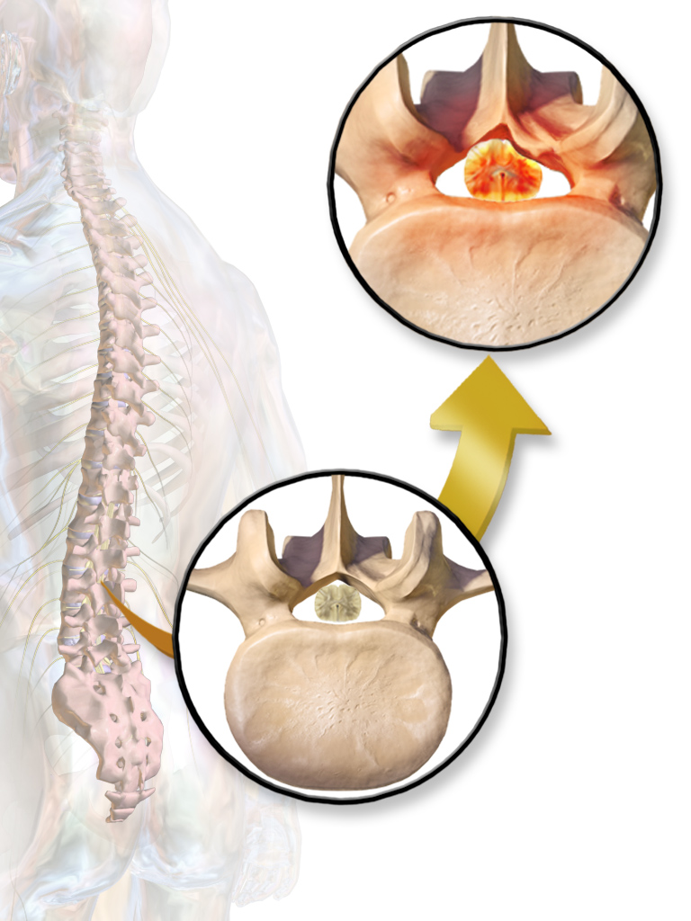 Spinal Stenosis Treatment: Causes, Symptoms & Best Recovery Options