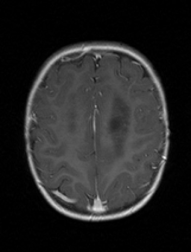 Medulloblastoma Treatment: Surgery, Radiation & Care