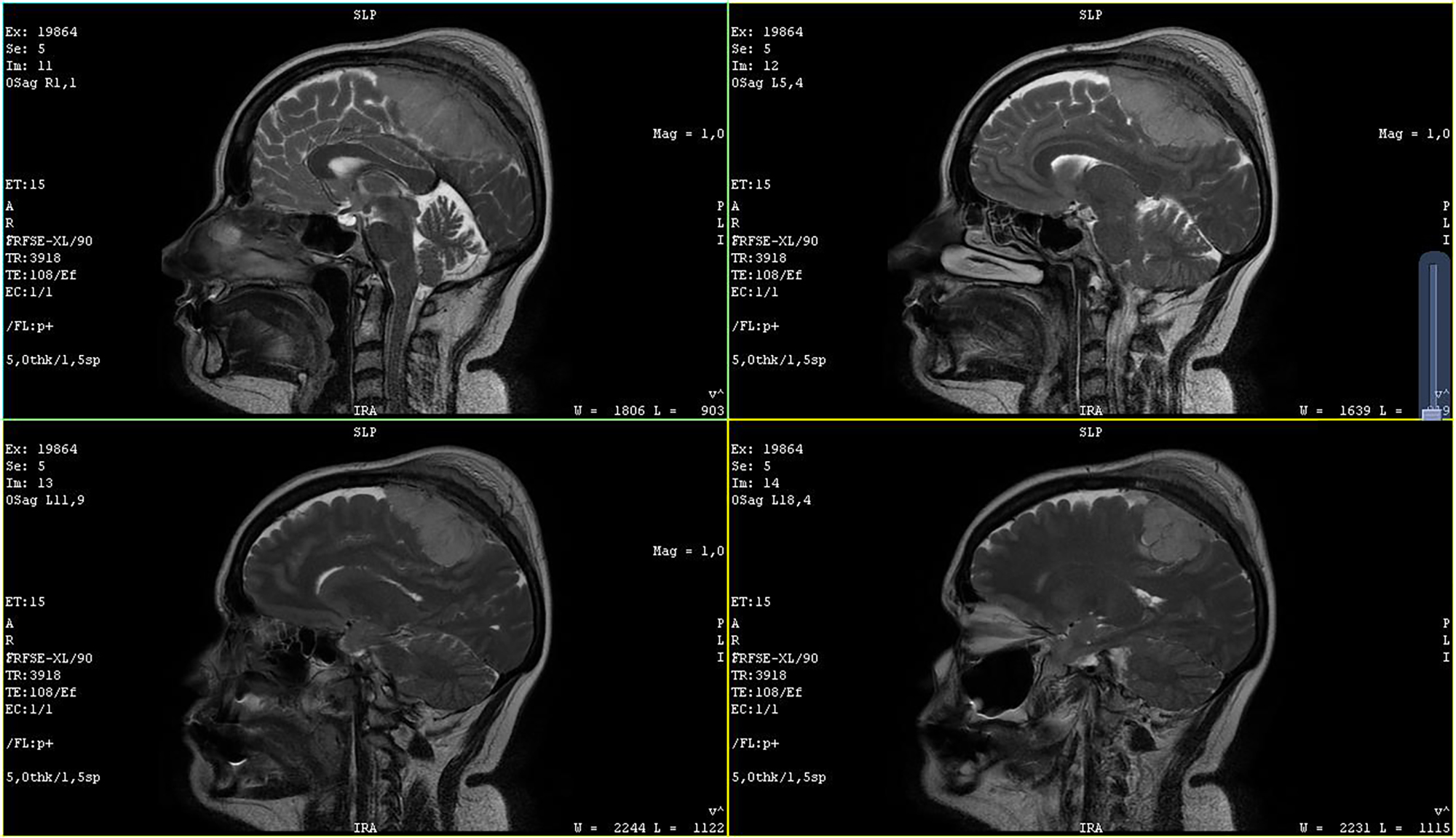 Meningioma Treatment: Symptoms, Surgery & Radiation Options