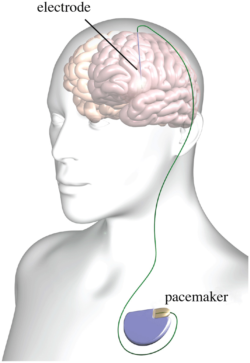 Movement Disorder Treatment: Tremor, Therapy & DBS Surgery