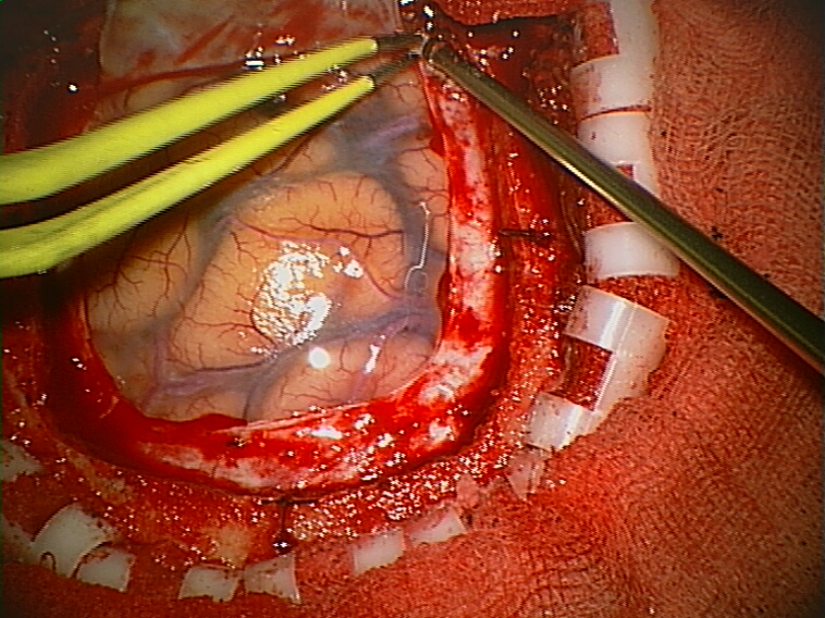 Neuroendoscopy: Keyhole Brain Surgery, Uses & Recovery