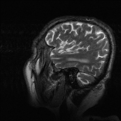 Normal Pressure Hydrocephalus Treatment: Shunt & Care