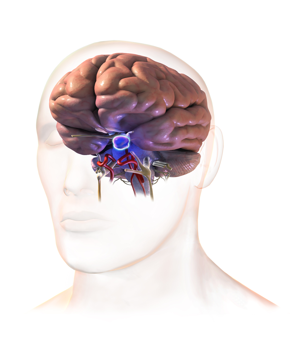 Pituitary tumor diagram Diagram of a pituitary tumor at the base of the brain, relevant to pituitary tumor treatment