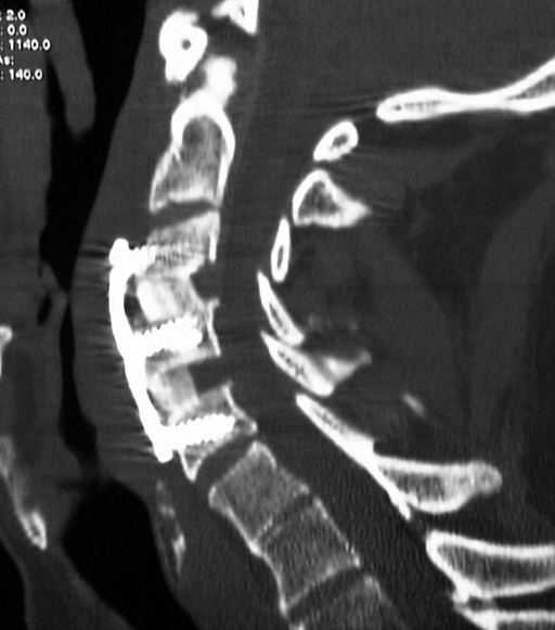 Sciatica Surgery: When It Helps, Types & Recovery