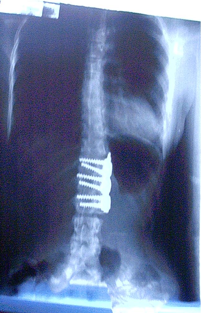 Scoliosis Treatment: Symptoms, Bracing & Spine Surgery