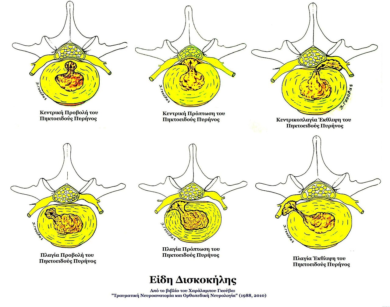 Slip disc (herniated disc) diagram Diagram of a herniated (slip) disc pressing on a spinal nerve at different levels of the spine