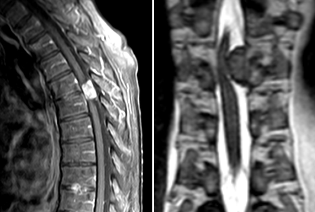 Spinal AVM Treatment: Symptoms, Surgery & Recovery