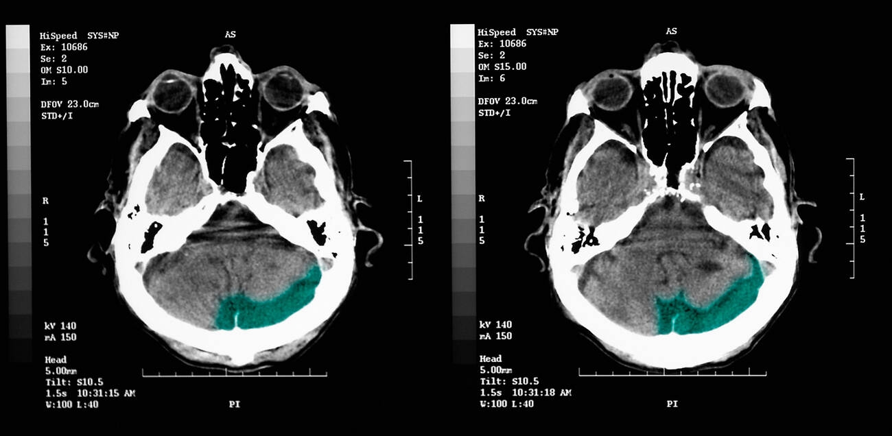 Spinal Cord Injury Treatment: Emergency Care, Surgery & Rehab