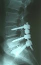 Spinal Fusion Surgery: Procedure, Recovery & Benefits