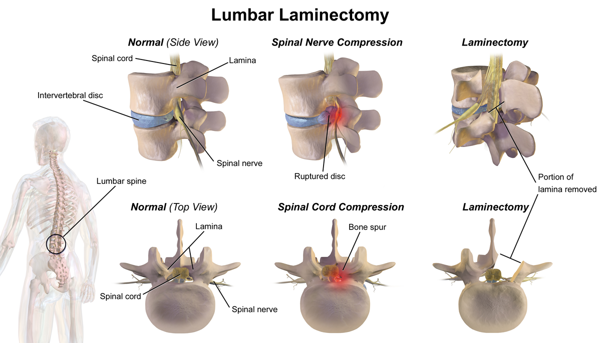 Spine Surgery: Types, When You Need It & Recovery Guide