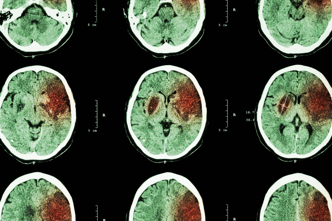 Stroke Treatment: Warning Signs, Emergency Care & Recovery
