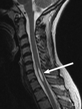 Syringomyelia Treatment: Symptoms, Surgery & Recovery