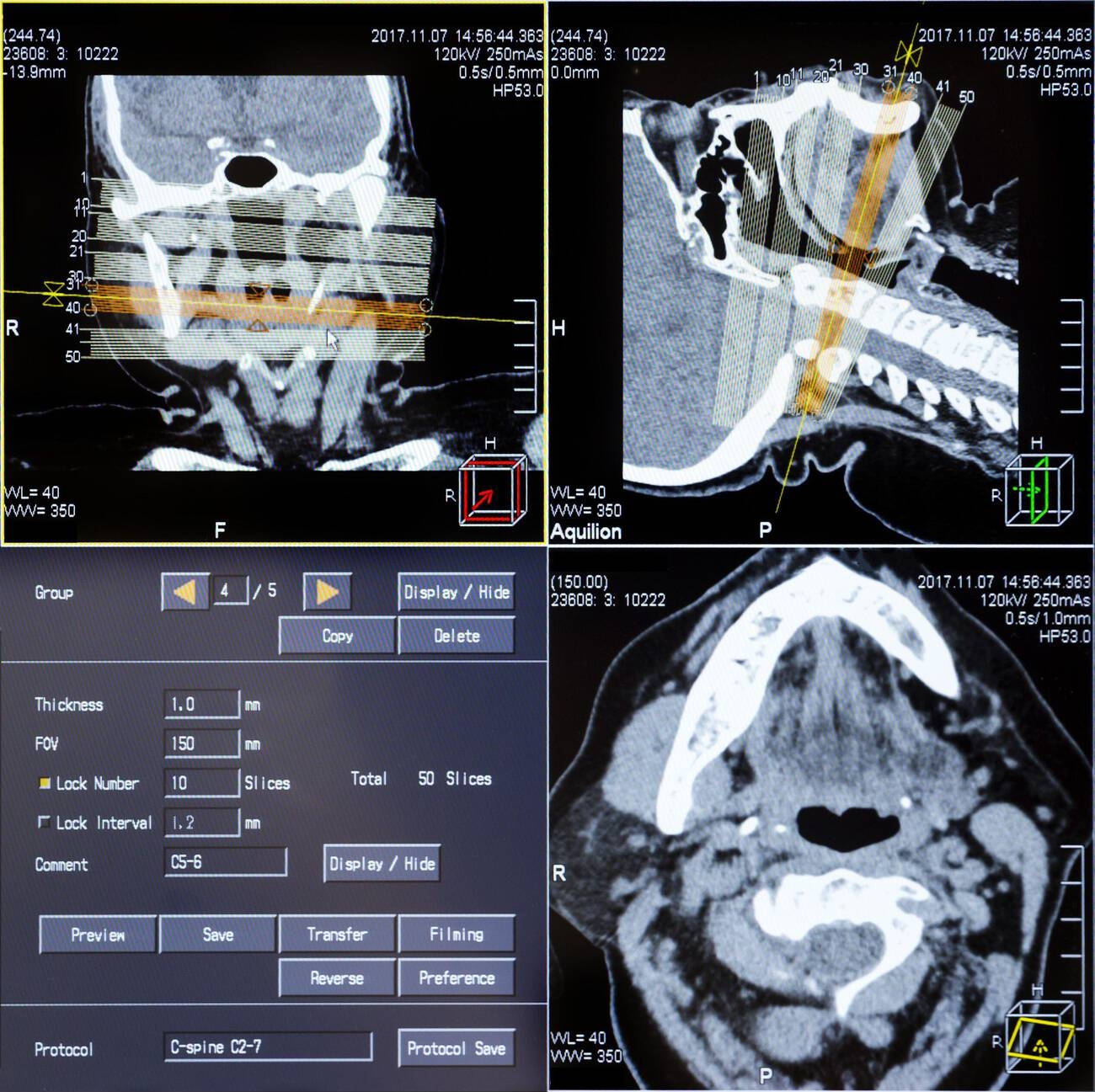 Traumatic Brain Injury Treatment: Care, Surgery & Rehab